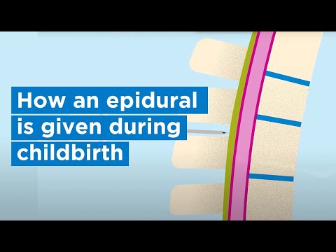 How an epidural is given during childbirth