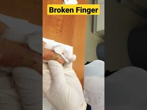 Broken Finger ✓✓✓✓